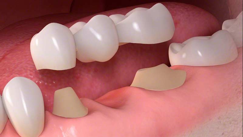 Come sostituire un dente mancante: 2 soluzioni