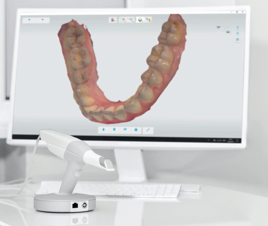 Impronta dentale digitale