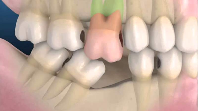 Denti storti dopo la perdita di un dente