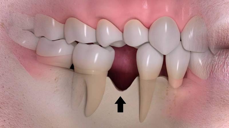 Ritiro dell'osso dopo la perdita di un dente