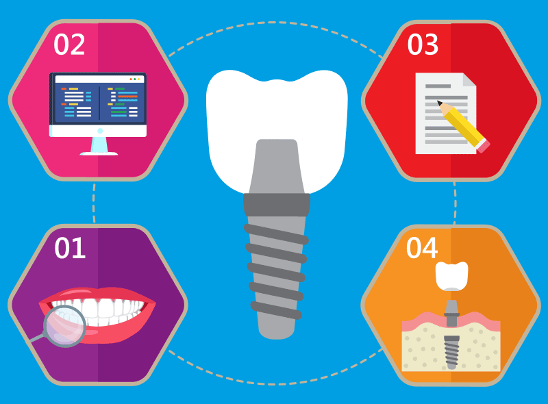 Impianti dentali: procedura dalla prima visita all'intervento