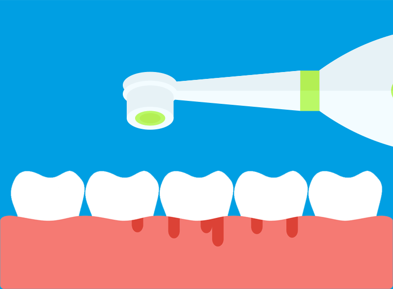 Gengivite: sintomi e come curarla