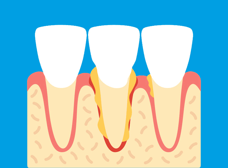 Parodontite: sintomi e come curarla