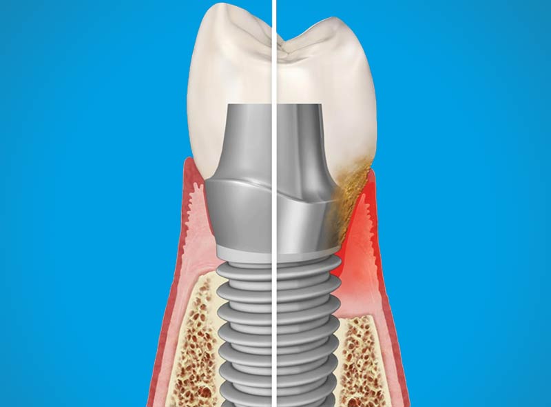 Impianto dentale con perimplantite sui tessuti