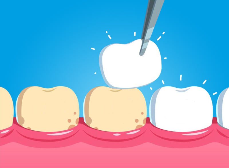 Faccette dentali: cosa sono