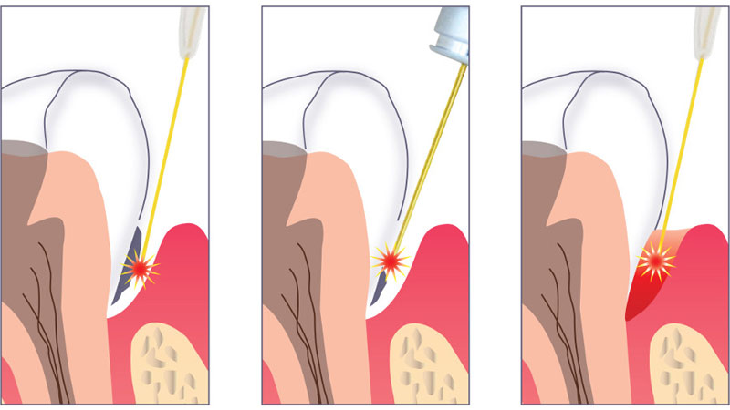 Trattamento laser per parodontite