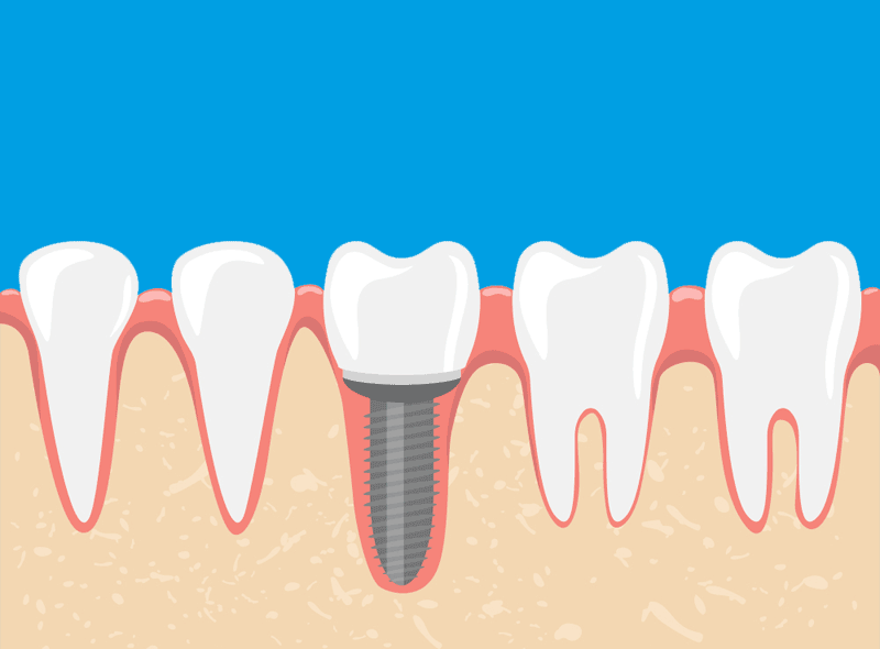 Denti fissi con poco osso: è possibile metterli?