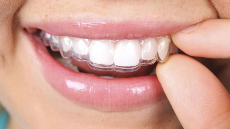 Allineatori trasparenti: sorriso perfetto senza limiti