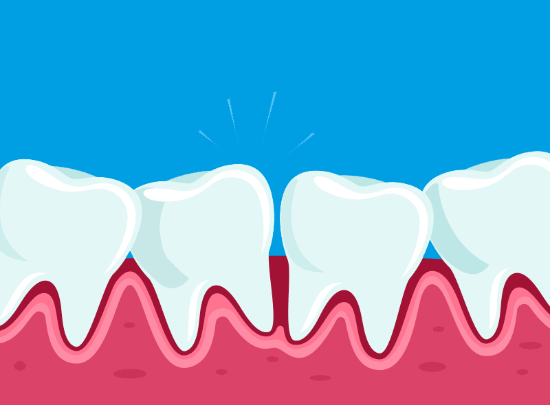 Come raddrizzare i denti da adulti