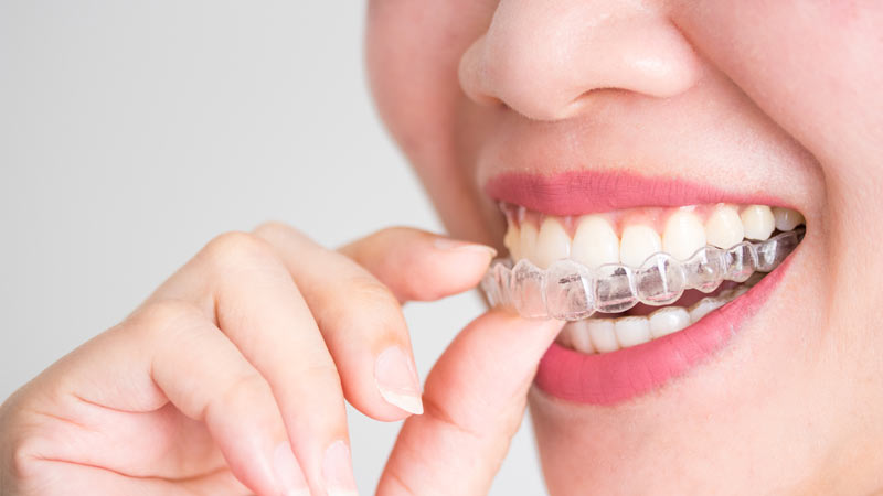 Donna indossa Invisalign