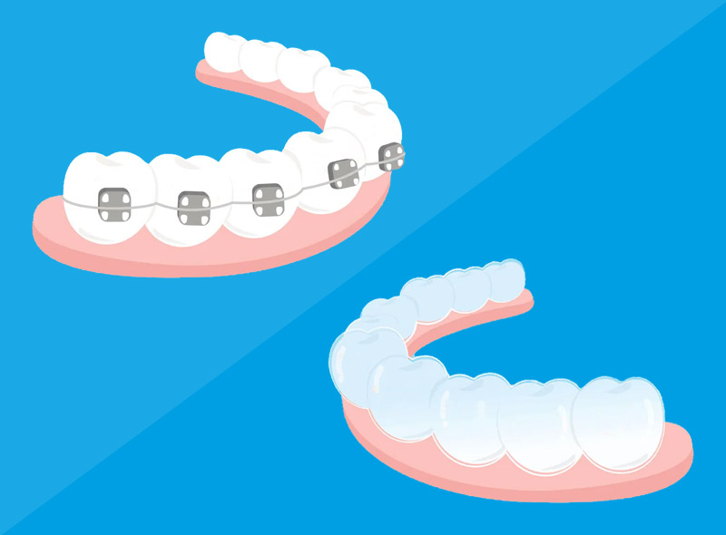 È meglio Invisalign o l'apparecchio fisso?