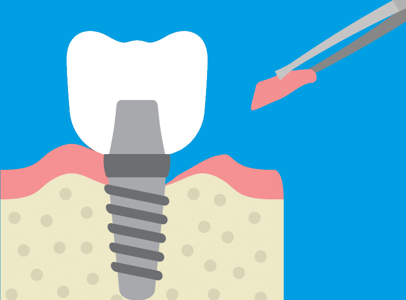 Innesto di gengiva su impianto dentale