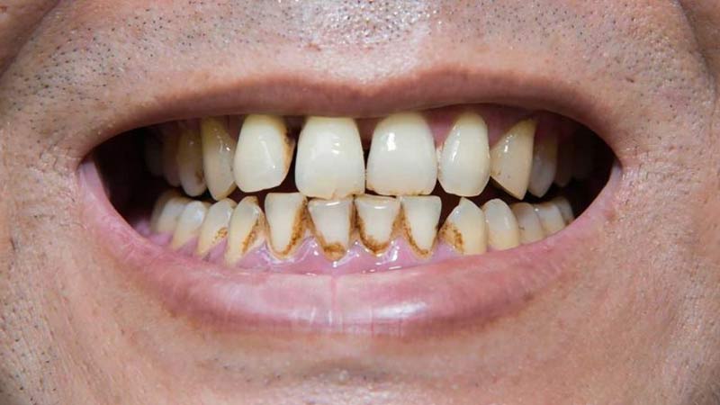 Macchie sui denti: 3 rimedi per toglierle