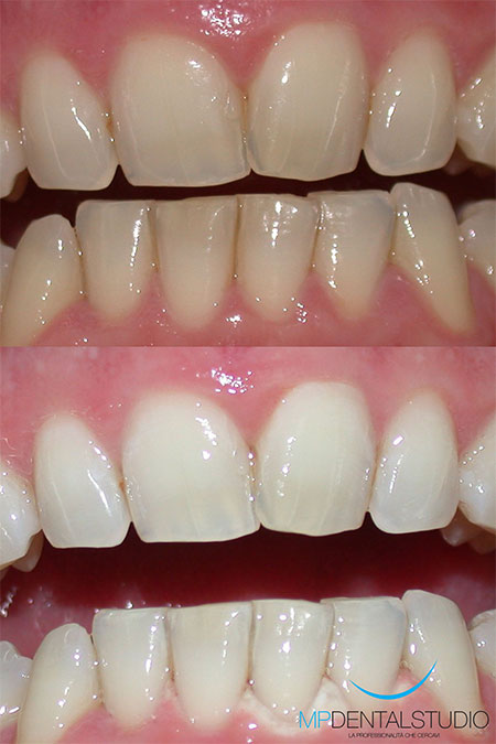 Sbiancamento dentale domiciliare: prima e dopo
