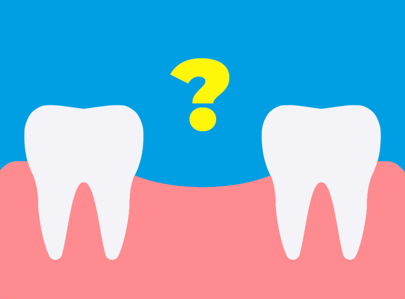 5 motivi per sostituire i denti mancanti con gli impianti dentali