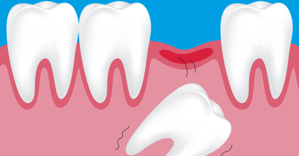 Denti da latte da adulti: cosa fare quando cadono