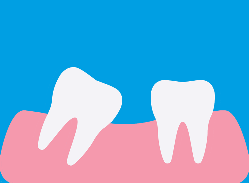 Non c'è spazio per gli impianti dentali? Ecco l'ortodonzia preprotesica