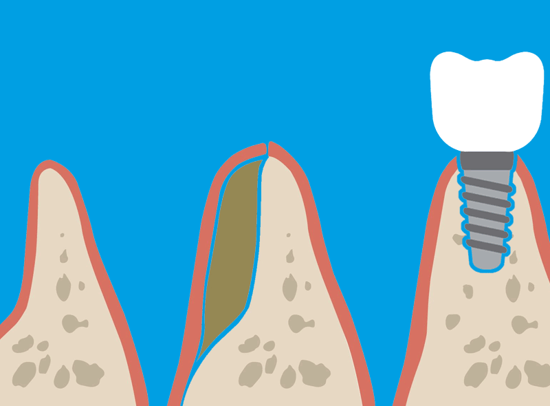 Rigenerazione ossea dentale: mettere gli impianti quando sembra impossibile