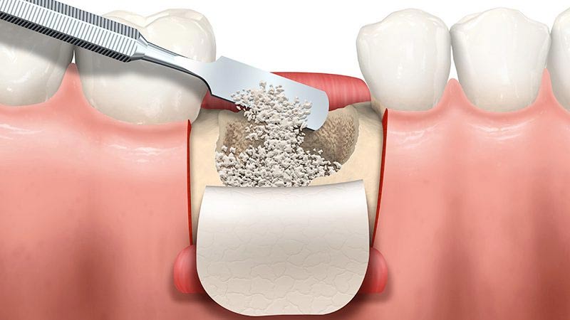 Rigenerazione ossea dentale