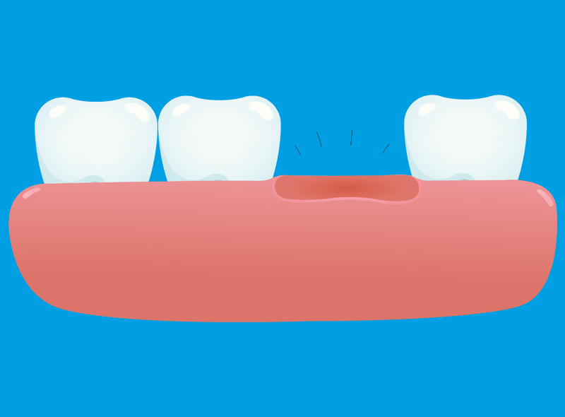 Agenesia dentale: cosa fare se ti manca un dente dalla nascita