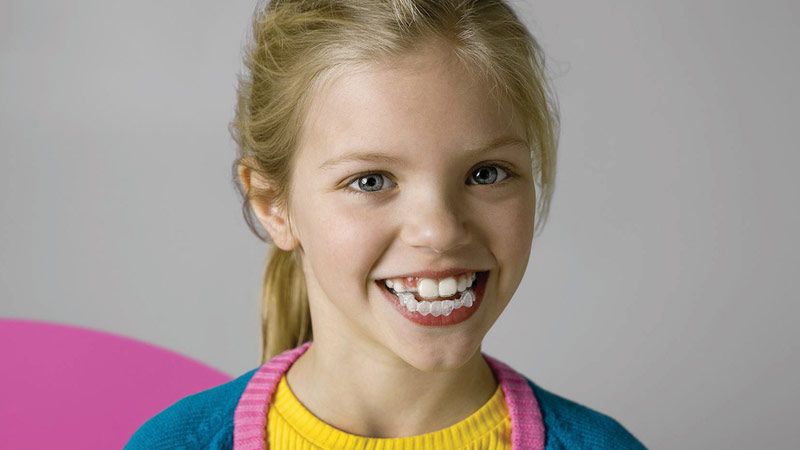 Una bambina sorridente indossa un allineatore ortodontico trasparente