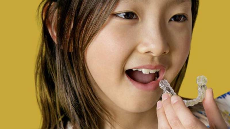 Bambina indossa un allineatore ortodontico trasparente