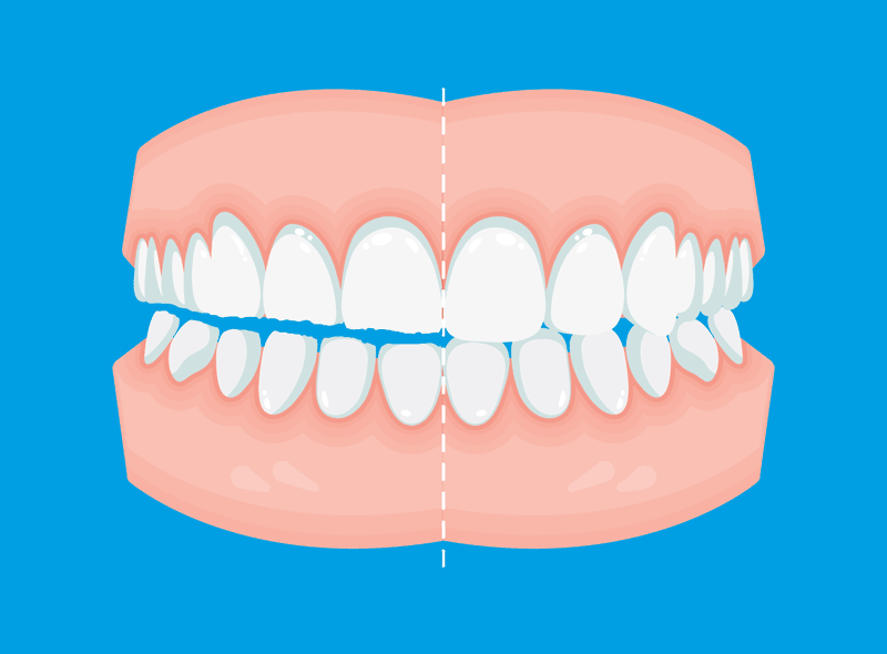 Soffri di bruxismo? Perché risolverlo prima di mettere un impianto