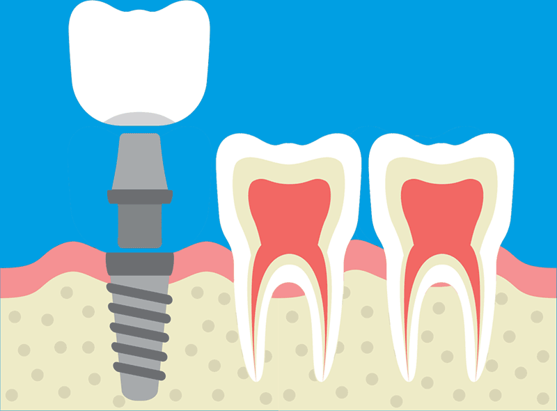 Impianti dentali in zona estetica: perché valutare l'osso prima di inserirli?
