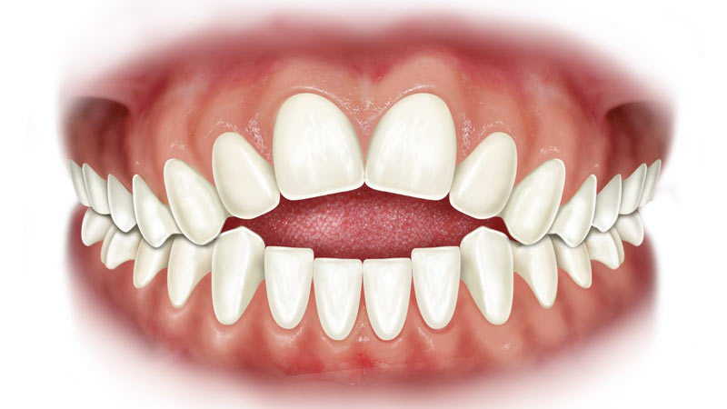 Morso aperto anteriore, malocclusione dentale