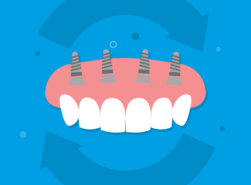 A cosa serve la protesi provvisoria su impianti dentali?