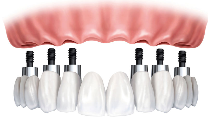 Ponte circolare su impianti dentali