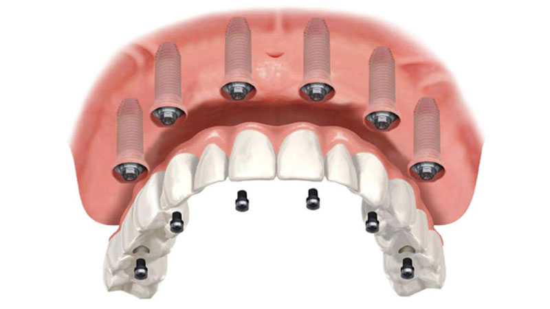 Protesi dentaria fissa su 6 impianti dentali