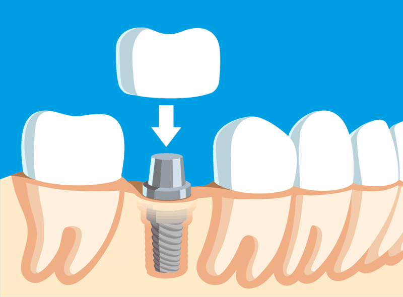 Impianti dentali: meglio una corona avvitata o cementata?
