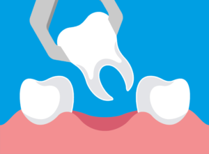 Ortodonzia: i problemi scheletrici che necessitano estrazioni