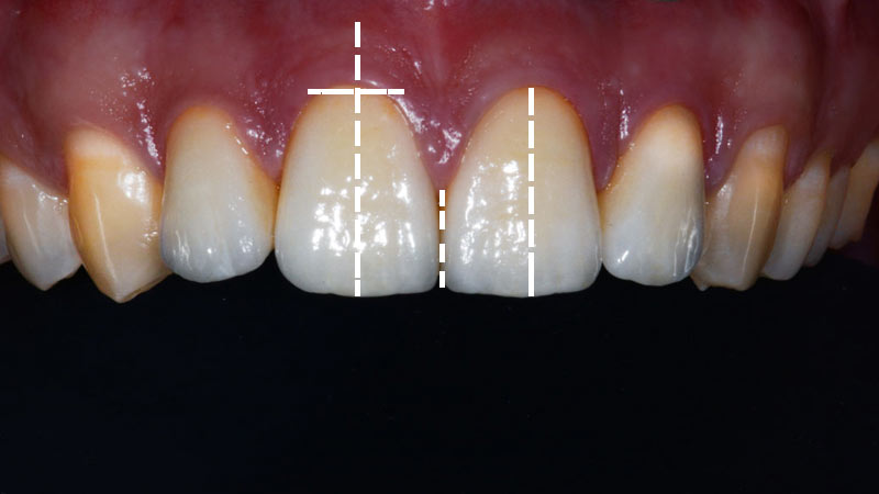 Studio della microestetica in ortodonzia