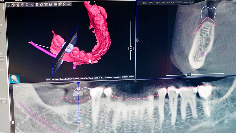 Progettazione dell'intervento di implantologia dentale con il sistema digitale Smart Implant