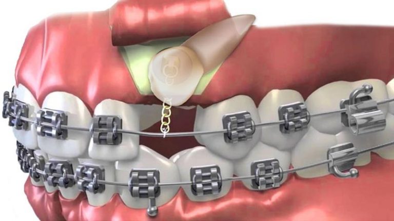 Canini inclusi: quali soluzioni per farli scendere? | MP Dental Studio