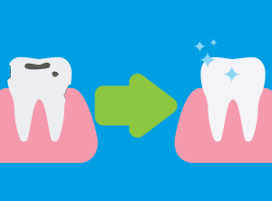 Estrusione ortodontica: come evitare di togliere un dente compromesso