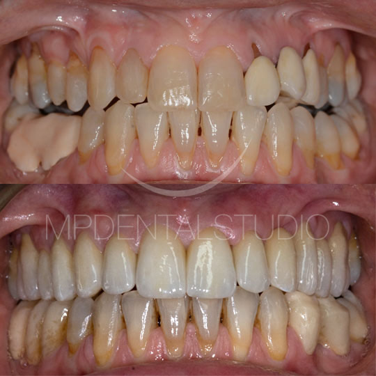 Corone in zirconio-ceramica