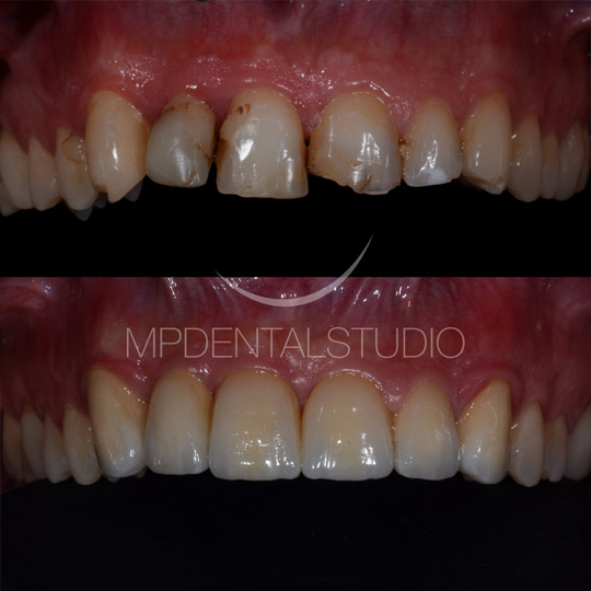 Corone in zirconio-ceramica