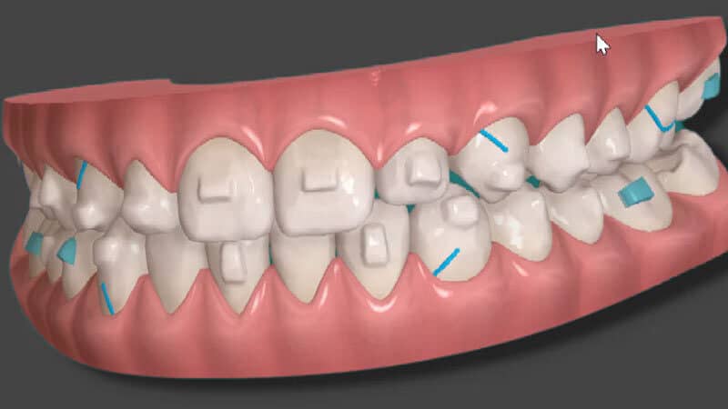 Invisalign a Verona - Ortodonzia Invisibile